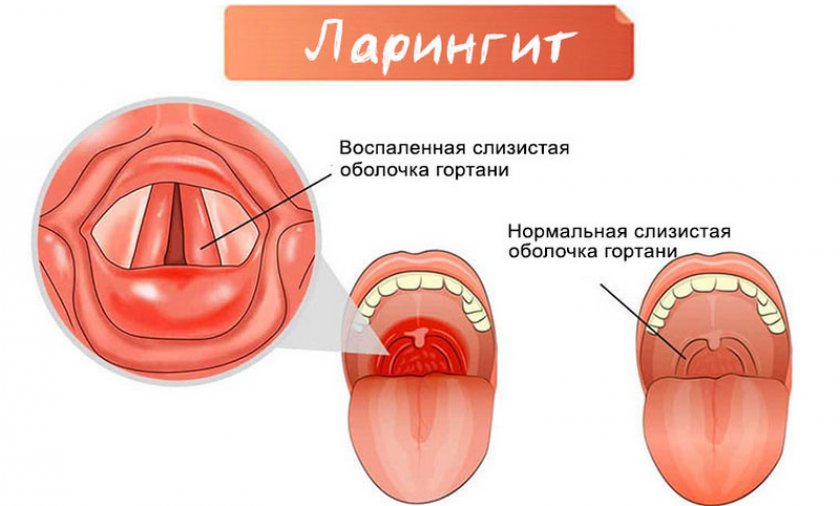 Ларингит
