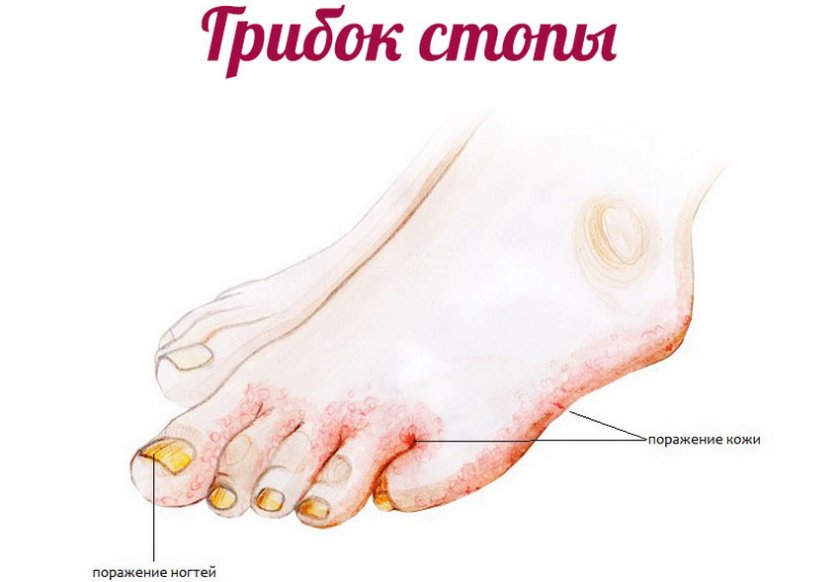 Грибок стоп