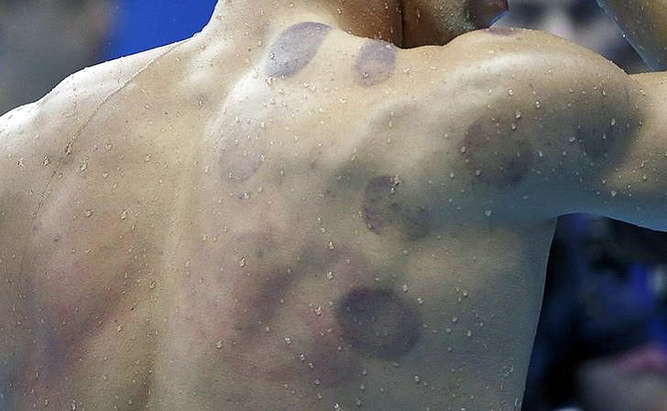 Раскрыт секрет побед Майкла Фелпса: видели на его фотографиях следы на плечах и спине? Это от банок! Фото: REUTERS